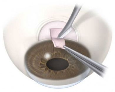 Trabeculectomie