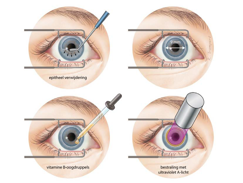 Crosslinking Trompert