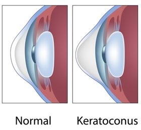 Afbeelding 1: links normaal hoornvlies, rechts keratoconus 	Geraadpleegd van: https://keratoconuscenter.eu/en/ 