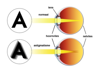 Astigmatisme